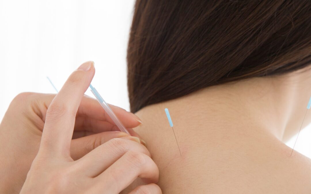 A Woman Recieving Acupuncture for Anxiety From a Total Healthcare Providor
